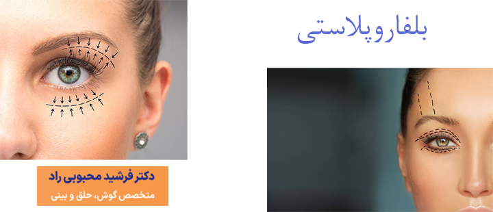 بلفاروپلاستی چیست؟