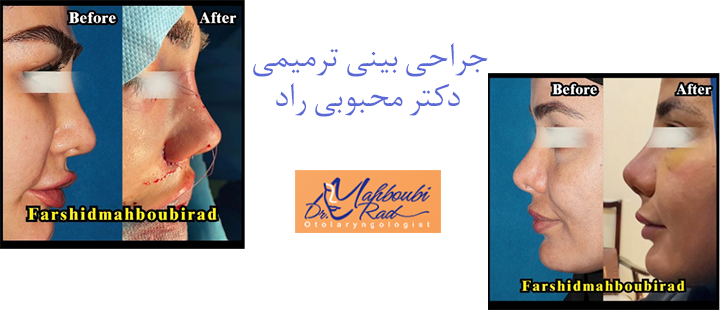 جراحی بینی ترمیمی دکتر محبوبی راد