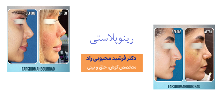 درباره رینوپلاستی 