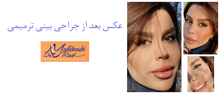 عکس بعد از جراحی بینی ترمیمی 