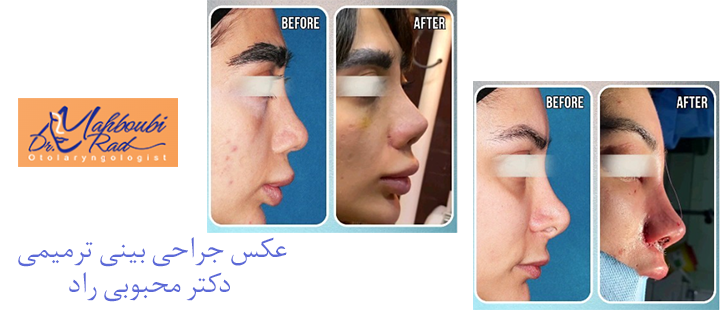 قبل و بعد جراحی بینی ترمیمی
