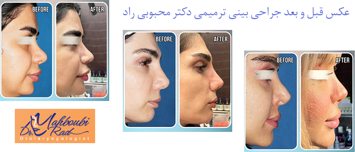 عکس قبل و بعد جراحی بینی ترمیمی دکتر محبوبی راد 