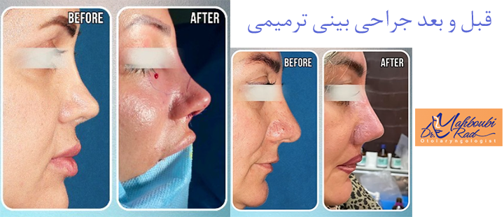 قبل و بعد جراحی بینی ترمیمی