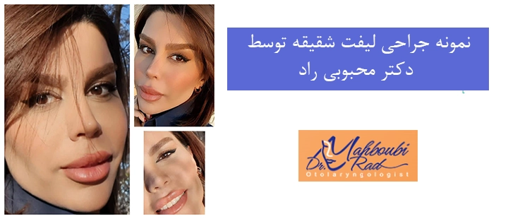 نمونه جراحی لیفت شقیقه دکتر محبوبی راد 