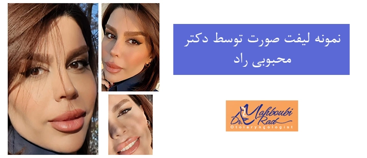نمونه لیفت صورت توسط دکتر محبوبی راد 