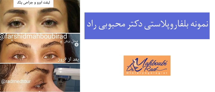 نمونه بلفاروپلاستی دکتر محبوبی راد