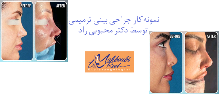 نمونه کار جراحی بینی ترمیمی توسط دکتر محبوبی راد 