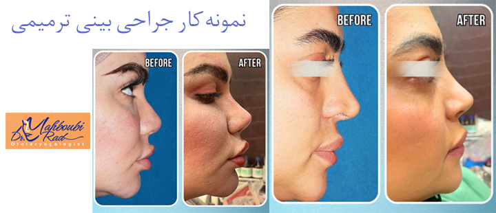 نمونه کار جراحی بینی ترمیمی 
