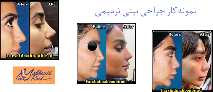 نمونه کار جراحی بینی ترمیمی 