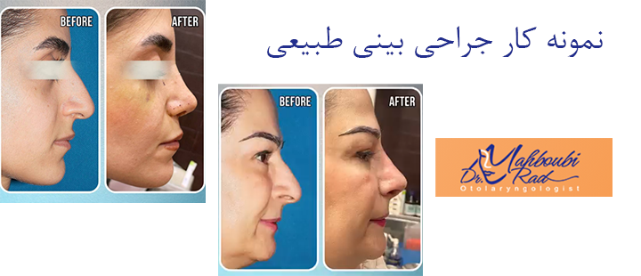 جراحی بینی دکتر محبوبی راد 