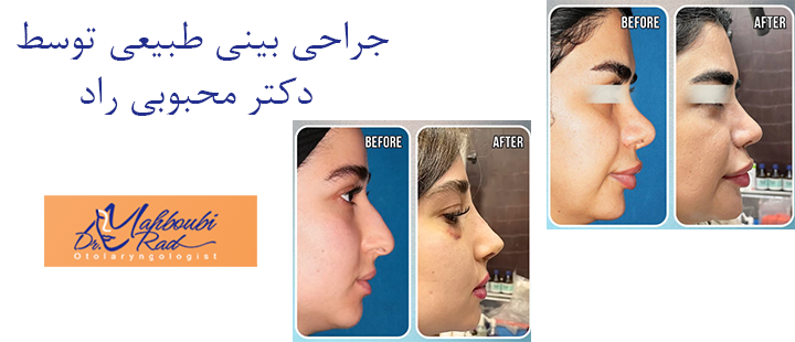 جراحی بینی طبیعی توسط دکتر محبوبی راد 