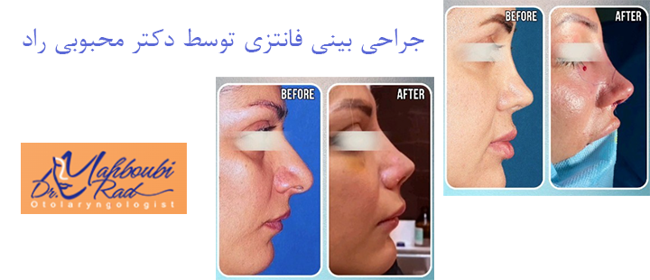 جراحی بینی فانتزی توسط دکتر محبوبی راد 