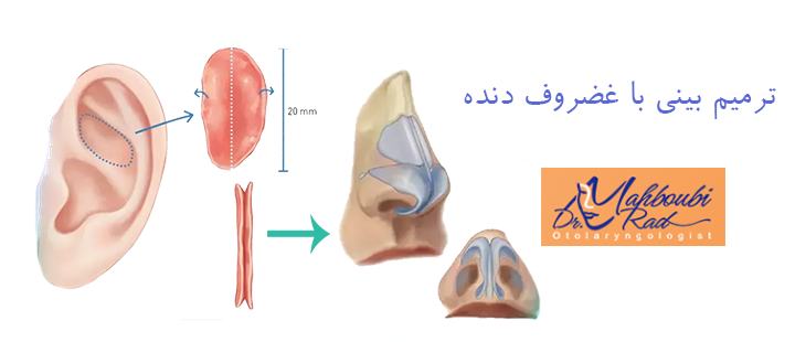 درباره ترمیم بینی با غضروف دنده