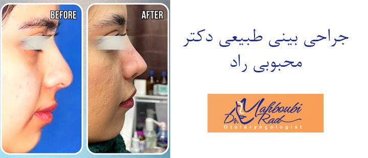عمل بینی طبیعی دکتر محبوبی راد 
