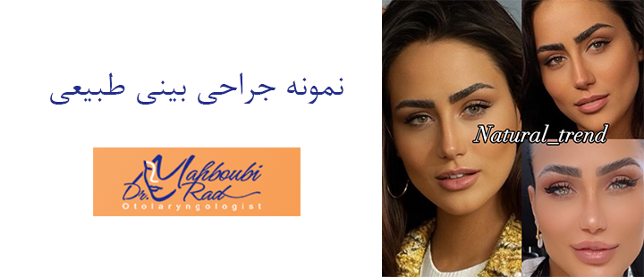 نمونه جراحی بینی طبیعی 