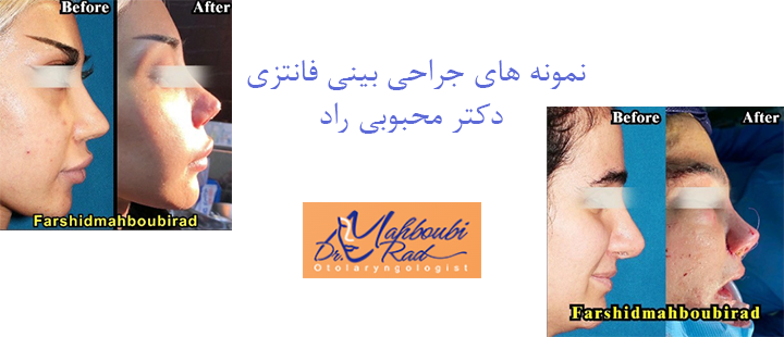 نمونه های جراحی بینی فانتزی دکتر محبوبی راد 