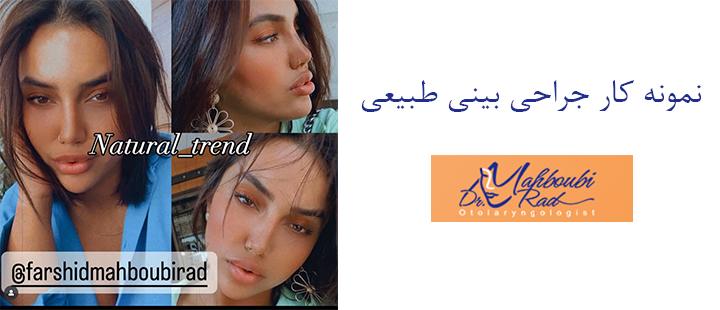 نمونه کار جراحی بینی طبیعی 