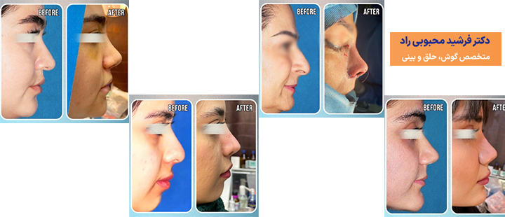 نمونه کار جراحی بینی فانتزی دکتر محبوبی راد 