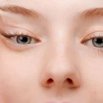 لیفت آندوسکوپی شقیقه