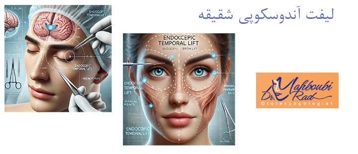 لیفت آندوسکوپی شقیقه چیست؟