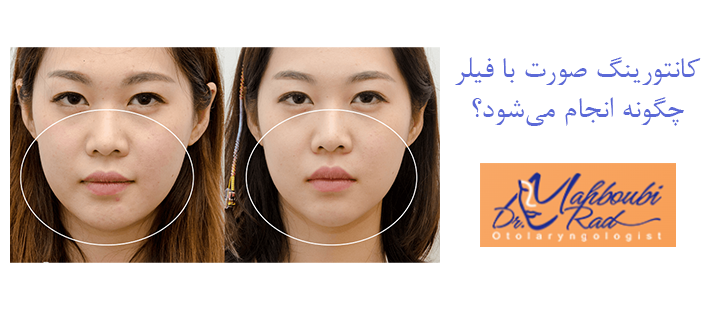 آَشنایی با کانتورینگ صورت با فیلر 