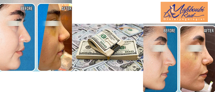 هزینه جراحی بینی در 1403