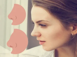 جراحی بینی گوشتی