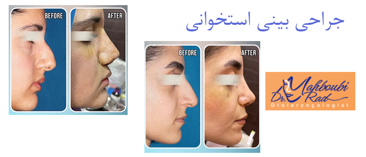 درباره جراحی بینی استخوانی 