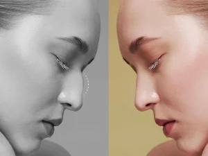 عمل بینی استخوانی