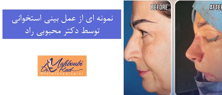 نمونه ای از عمل بینی استخوانی توسط دکتر محبوبی راد 