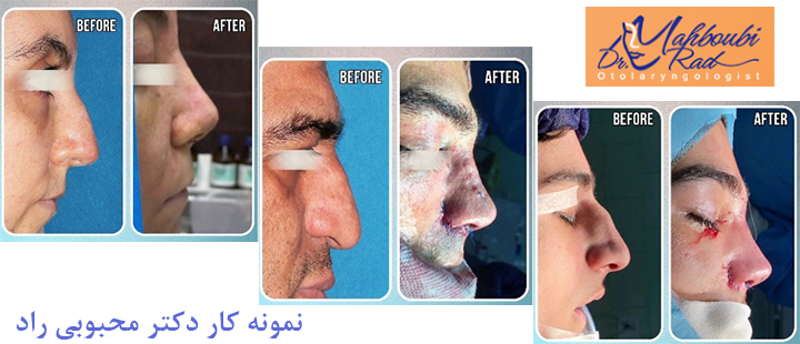 نمونه کار جراجی بینی استخوانی 