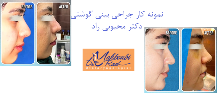 نمونه کار جراحی بینی گوشتی 