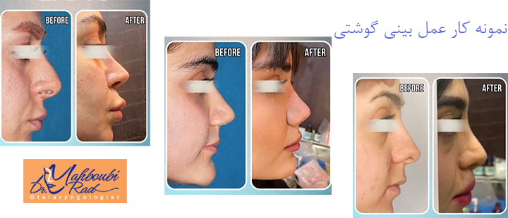 نمونه کار عمل بینی گوشتی 