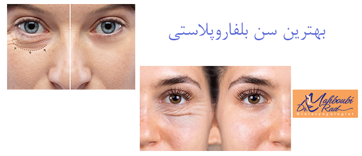 بهترین سن بلفاروپلاستی 