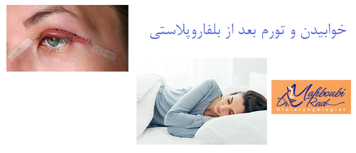 خوابیدن و تورم بعد از بلفاروپلاستی 