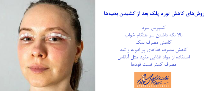روش‌های کاهش تورم پلک بعد از کشیدن بخیه‌ها