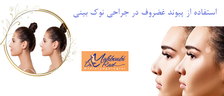 استفاده از پیوند غضروف در جراحی نوک بینی 