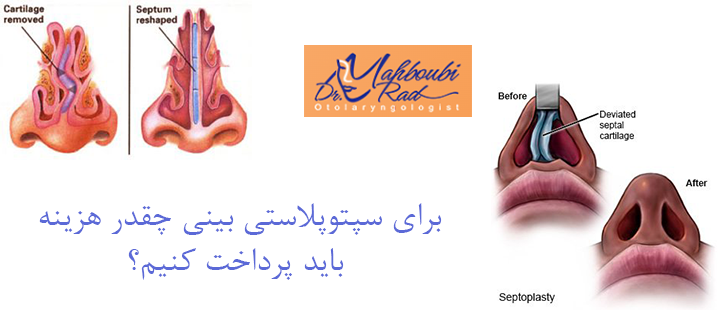 برای هزینه سپتوپلاستی چقدرهزینه باید پرداخت کنیم؟