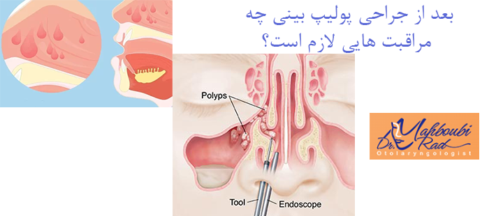 بعد از جراحی پولیپ بینی چه مراقبت هایی لازم است؟