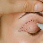 جای بخیه بلفاروپلاستی
