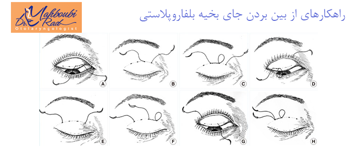 راهکارهای از بین بردن جای بخیه بلفاروپلاستی 