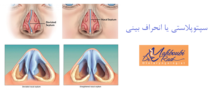 سپتوپلاستی چیست؟