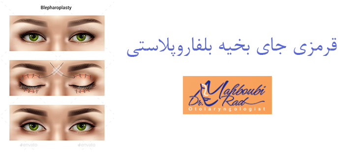 قرمزی جای بخیه بلفاروپلاستی 