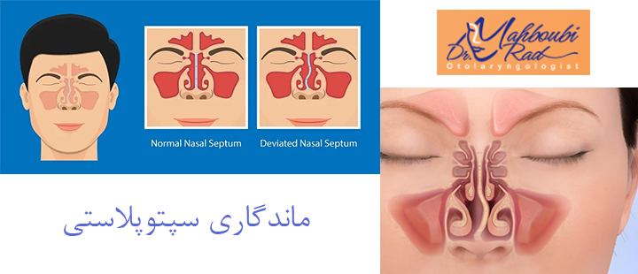 ماندگاری سپتوپلاستی 