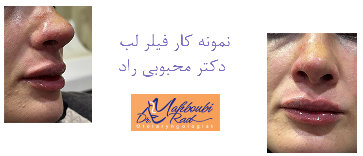 نمونه کار فیلر لب دکتر محبوبی راد 