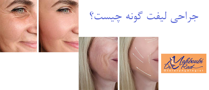 جراحی لیفت گونه چیست؟