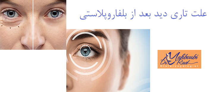 علت تاری دید بعد از بلفاروپلاستی 