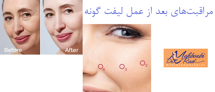 مراقبت‌های بعد از عمل لیفت گونه