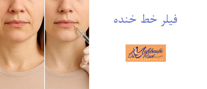 فیلر خط خنده چیست؟