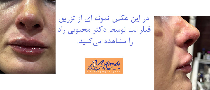 عکس بعد از تزریق فیلر دکتر محبوبی راد 